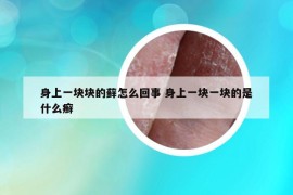 身上一块块的藓怎么回事 身上一块一块的是什么癣