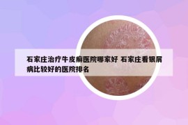 石家庄治疗牛皮癣医院哪家好 石家庄看银屑病比较好的医院排名