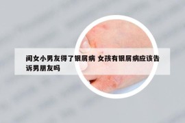 闺女小男友得了银屑病 女孩有银屑病应该告诉男朋友吗