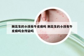 刚出生的小孩有牛皮癣吗 刚出生的小孩有牛皮癣吗会传染吗