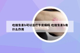 吃维生素b可以治疗牛皮癣吗 吃维生素b有什么作用