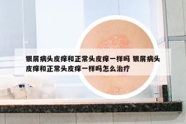 银屑病头皮痒和正常头皮痒一样吗 银屑病头皮痒和正常头皮痒一样吗怎么治疗