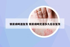 银屑病喝酒复发 银屑病喝完酒多久后会复发