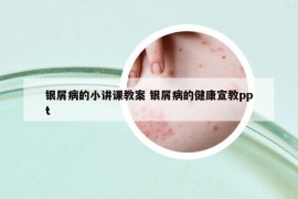 银屑病的小讲课教案 银屑病的健康宣教ppt