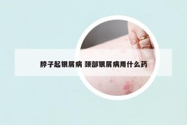 脖子起银屑病 颈部银屑病用什么药