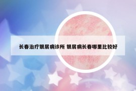 长春治疗银屑病诊所 银屑病长春哪里比较好