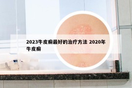 2023牛皮癣最好的治疗方法 2020年牛皮癣