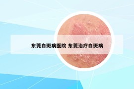 东莞白斑病医院 东莞治疗白斑病