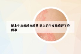 腿上牛皮癣越来越重 腿上的牛皮肤癣好了咋回事