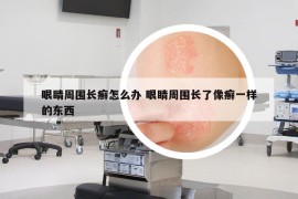 眼睛周围长癣怎么办 眼睛周围长了像癣一样的东西