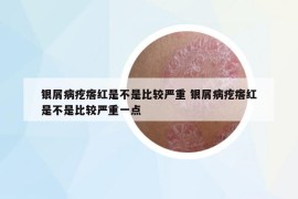 银屑病疙瘩红是不是比较严重 银屑病疙瘩红是不是比较严重一点