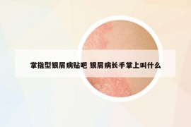 掌指型银屑病贴吧 银屑病长手掌上叫什么