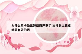 为什么用卡泊三醇反而严重了 治疗头上银皮癣最有效的药