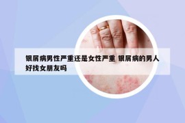 银屑病男性严重还是女性严重 银屑病的男人好找女朋友吗
