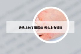 舌头上长了银屑病 舌头上有银珠