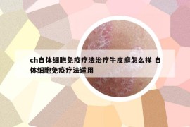 ch自体细胞免疫疗法治疗牛皮癣怎么样 自体细胞免疫疗法适用