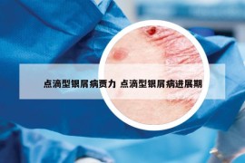 点滴型银屑病贾力 点滴型银屑病进展期