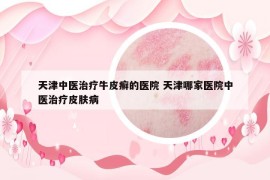 天津中医治疗牛皮癣的医院 天津哪家医院中医治疗皮肤病