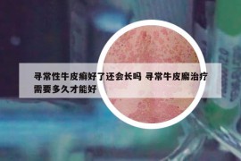 寻常性牛皮癣好了还会长吗 寻常牛皮廨治疗需要多久才能好