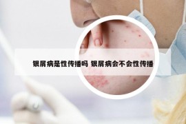 银屑病是性传播吗 银屑病会不会性传播