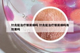 针灸能治疗银屑病吗 针灸能治疗银屑病吗有效果吗