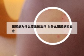 银屑病为什么要系统治疗 为什么银屑病能自愈