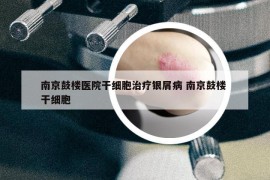 南京鼓楼医院干细胞治疗银屑病 南京鼓楼 干细胞