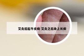 艾灸后起牛皮癣 艾灸之后身上长癣