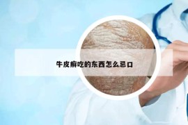 牛皮癣吃的东西怎么忌口