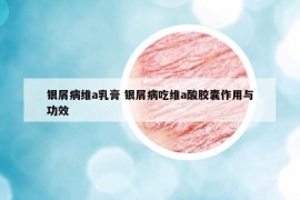银屑病维a乳膏 银屑病吃维a酸胶囊作用与功效