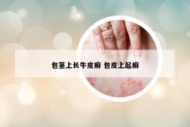 包茎上长牛皮癣 包皮上起癣