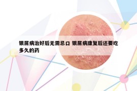 银屑病治好后无需忌口 银屑病康复后还要吃多久的药