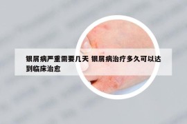 银屑病严重需要几天 银屑病治疗多久可以达到临床治愈