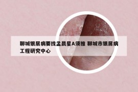 聊城银屑病要找孟晨星A须推 聊城市银屑病工程研究中心