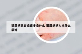 银屑病患者应该多吃什么 银屑病病人吃什么最好