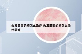 头发里面的癣怎么治疗 头发里面的癣怎么治疗最好