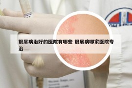 银屑病治好的医院有哪些 银屑病哪家医院专治