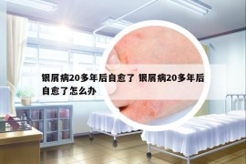 银屑病20多年后自愈了 银屑病20多年后自愈了怎么办