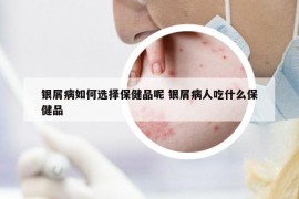 银屑病如何选择保健品呢 银屑病人吃什么保健品