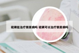 硫磺能治疗银屑病吗 硫磺可以治疗银屑病吗