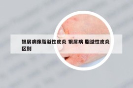 银屑病像脂溢性皮炎 银屑病 脂溢性皮炎 区别