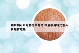 银屑病可以吃特比萘芬马 银屑病用特比萘芬片后有效果