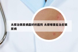 太原治银屑病最好的医院 太原哪里能治愈银屑病
