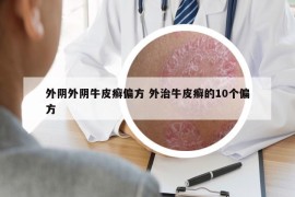 外阴外阴牛皮癣偏方 外治牛皮癣的10个偏方