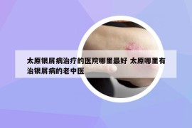 太原银屑病治疗的医院哪里最好 太原哪里有治银屑病的老中医