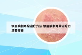 银屑病割耳朵治疗方法 银屑病割耳朵治疗方法有哪些