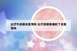化疗牛皮癣会复发吗 化疗后银屑病好了会复发吗