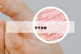 孕牛皮癣