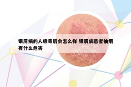 银屑病的人吸毒后会怎么样 银屑病患者抽烟有什么危害
