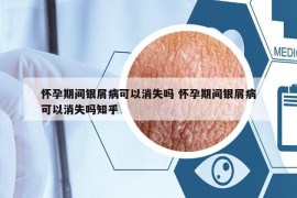 怀孕期间银屑病可以消失吗 怀孕期间银屑病可以消失吗知乎